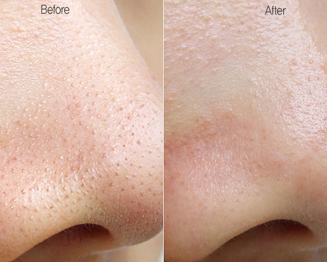  Trị Mụn Ẩn Và Mụn Cám Tại Sen Beauty